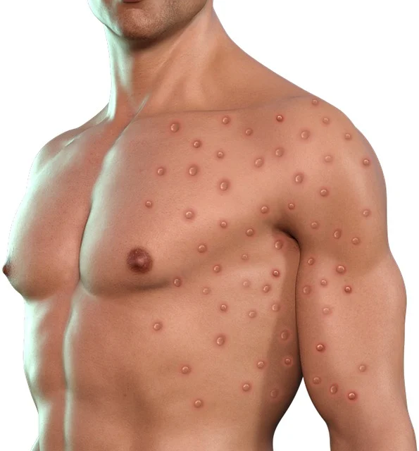 monkeypox-7219694_640